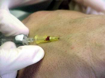 iv_catheter_patient1